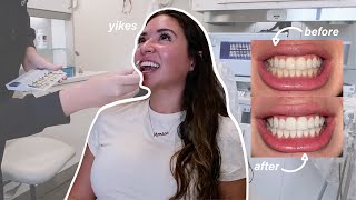 professionally whitening my teeth at the dentist after invisalign [upl. by Mikel]