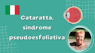 Cataratta sindrome pseudoesfoliativa [upl. by Ymled798]