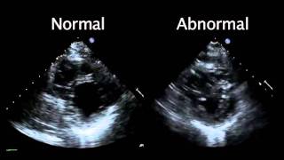 Echocardiogram from the Patient Compared with That from a Normal Control  NEJM [upl. by Lymann]