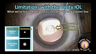 CataractCoach 1643 limitations with the Vivity IOL extended depth of focus [upl. by Dieball]