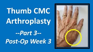 Thumb CMC Arthroplasty Part 3 PostOp Week 3 [upl. by Palma42]