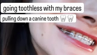 GO TOOTHLESS WHO CARES 😆🦷 Pulling down impacted adult Canine Tooth w tiny gold chain ⛓️ OUCH 😖 [upl. by Ced]