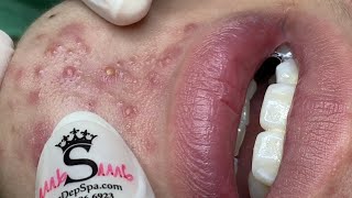 Big Cystic Acne Blackheads Extraction Blackheads amp Milia Whiteheads Removal Pimple Popping 95408 [upl. by Artenek]