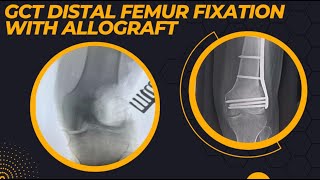 DISTAL FEMUR GCT WITH PATHOLOGICAL FRACTURE PLATING WITH ALLOGRAFT USED WITH EXCELLENT RESULT [upl. by Htidirrem607]