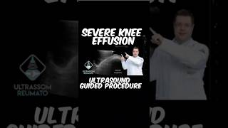 Severe Knee Effusion Ultrasound Guided Procedure [upl. by Mufinella539]