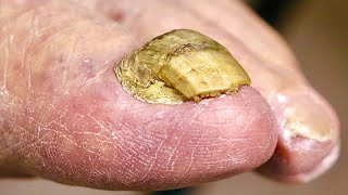 Super THICK BIG TOENAIL Trimming NAIL FUNGUS OR DAMAGED TOENAIL [upl. by Campy605]