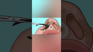 ASMR Nasal care Video  Bug Removal  Relaxing Asmrvidz007 youtube shorts [upl. by Aikat]