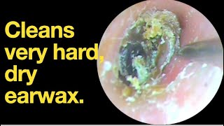 Cleans very hard dry earwax ear wax removal  ear cleaning  ASMR  relaxation  relax [upl. by Karna]