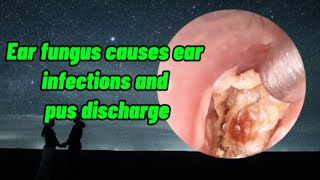 Ear fungus causes serious damage to the ears [upl. by Hnahym]