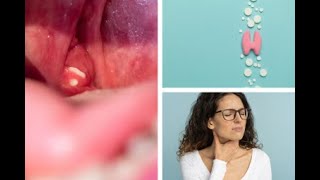 Removing Tonsil Stones At Home [upl. by Holmann]