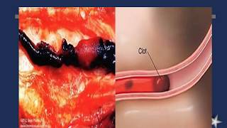 104 Arterial EmbolismPeripheral Vascular Diseases [upl. by Caines]