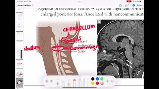 chiari 1 malformation neurology 7  First Aid USMLE Step 1 in UrduHindi [upl. by Rushing45]