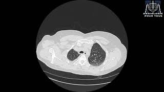 SCANNER THORACIQUE  Pleurésie bilatérale déjà traité pour TBK pulmonaire [upl. by Eiddam]