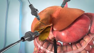 Laparoscopic and open cholecystectomy surgery animation [upl. by Ayanat866]