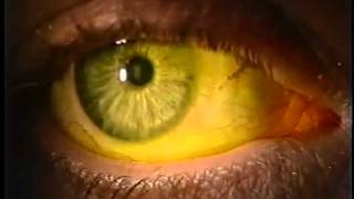 Instilling Fluorescein Dye in the Eye [upl. by Luann886]