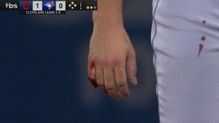 ALCS Gm3 Bauer leaves game with finger wound in 1st [upl. by Aymer]