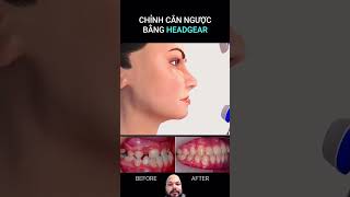 headgear orthodontics braces dentalcare satisfying [upl. by Arvy643]