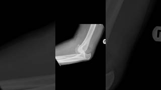 Posterior dislocation of the elbow with associated fracture of the coronoid process xray [upl. by Aikam752]