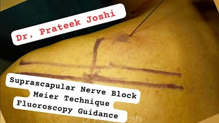 Suprascapular Nerve Block Procedure  Meier Technique  Fluoroscopy Guidance  Dr Prateek Joshi [upl. by Aden241]