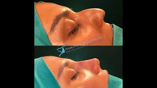 Aquiline Nose Rhinoplasty [upl. by Trebliw]