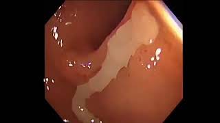 Diphyllobothrium latum on colonoscopy [upl. by Anon817]