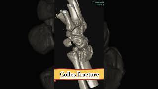 Colles Fracture  radiology viral shorts [upl. by Madison]