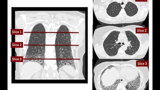 Autoimmune Connective Tissue Disease Related ILD Webinar [upl. by Abbi]