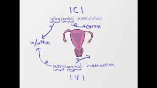 What is ICI Intracervical insemination [upl. by Saberio231]