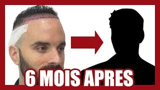 CALVITIE  MA GREFFE DE CHEVEUX  6 MOIS APRÈS [upl. by Amitarp]