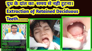 Extraction of Retained Deciduous Teethदूध के दांत का समय से नही टूटना। [upl. by Renick]