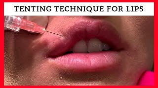 Tenting Technique for Lip Enhancement by Dr Steven F Weiner [upl. by Tavy]