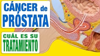 Cáncer de Próstata  Tratamiento [upl. by Otokam]