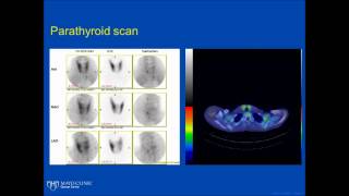 Basics of Multiple Endocrine Neoplasia [upl. by Brenna275]