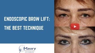 Endoscopic Brow Lift Video  Before amp After Brow Lift [upl. by Icam]