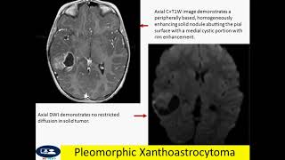 Pleomorphic Xanthoastrocytoma [upl. by Livvyy]