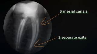 Mandibular molar with 6 canals A case for systematic preoperative CBCT [upl. by Mickey162]