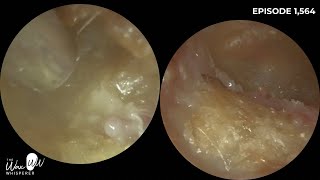 1564  Bilateral Rare Canal Cholesteotoma Patient Waiting 25 Years to be seen by ENT [upl. by Nyltac]