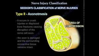 Nerve Injury types  Nerve recovery  Everything You Need To Know  Dr Nabil Ebraheim [upl. by Ardeahp]