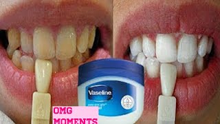 Dental Whitening Procedure Natural Bright Smile with Beyond Kit  General Dentist Griya RR [upl. by Tedie992]