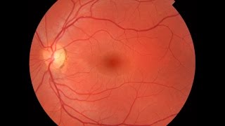 Practical Ophthalmology  Retina and Optic Nerve [upl. by Annair]