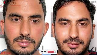 Otoplasty Otoplasty Recovery Otoplasty before and after pictures  Dr Vikas Gawri [upl. by Esinwahs]