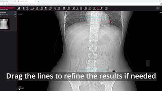 MedDream DICOM Viewer measure the Cobb angle [upl. by Ocirred]