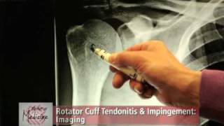 Rotator Cuff Impingement amp Tendonitis Part 2 Symptoms amp Evaluation [upl. by Ialda]