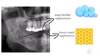 Ameloblastoma part 1 [upl. by Berkman]