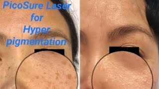 Best laser for pigmentation  picolaser treatment skinrejuvenation draqeel adeelmedics laser [upl. by Calvin245]