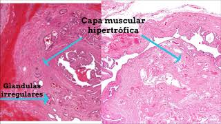 SALPINGITIS [upl. by Eca]