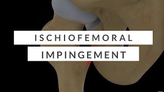 Ischiofemoral Impingement  A Nonsurgical Overview [upl. by Athenian745]