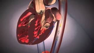 Cardiologie  TAVI Procedure EdwardsXT [upl. by Lawtun465]