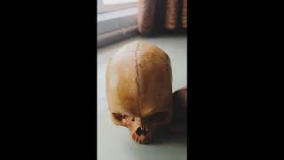 METOPIC SUTURE RAREST OF RARE FINDING IN HUMAN SKULL [upl. by Dorey]