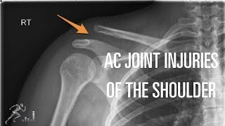 Acromioclavicular AC joint injury Mechanism of injury diagnosis and treatment [upl. by Lesslie]